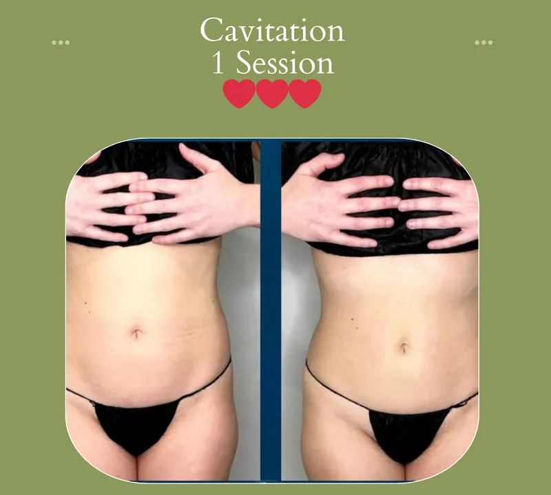 Cavitation before and after, stomach front, 1 session