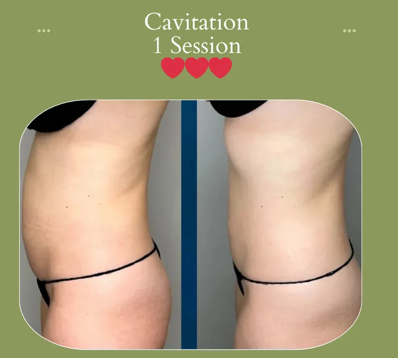 Cavitation before and after, stomach side, 1 session