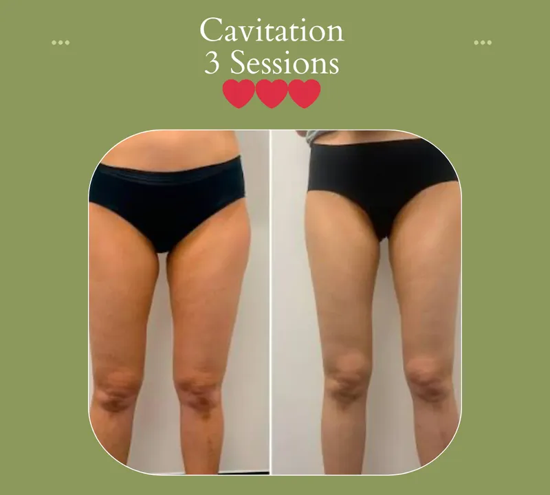 Cavitation before and after, thighs, 3 sessions