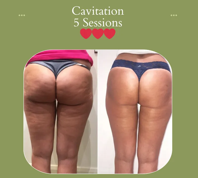 Cavitation before and after, buttocks, 5 sessions