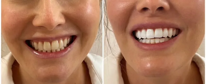 Teeth whitening before and after, smile close-up