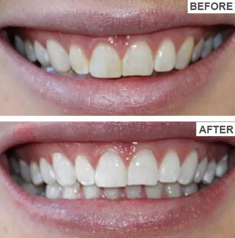 Teeth whitening before and after