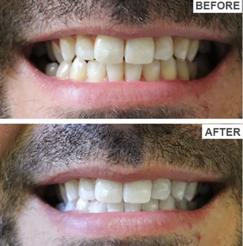 Teeth whitening before and after
