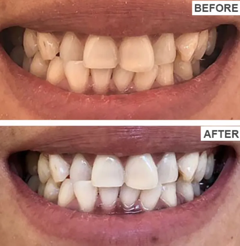 Teeth whitening before and after