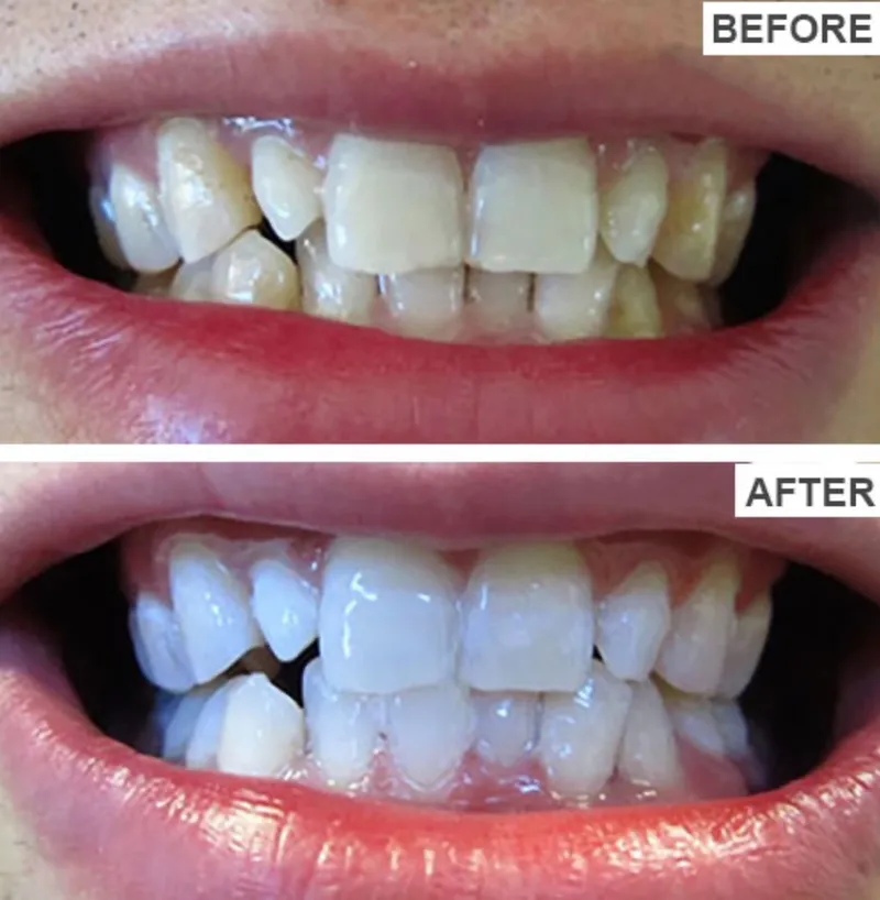Teeth whitening before and after